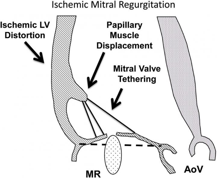 Updated AATS Guidelines Help Cardiovascular Surgeons Navigate the Challenges of Managing Ischemic Mitral Regurgitation