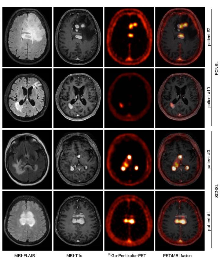CXCR4-directed PET correlates with MRI-determined lymphoma lesions.