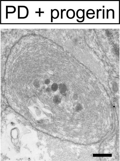Intracellular Aggregate in PD Neuron
