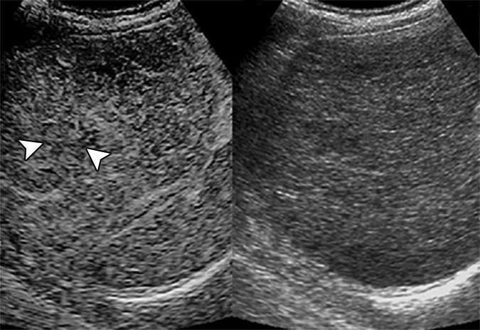 69-Year-Old Man with Cirrhotic Nodule