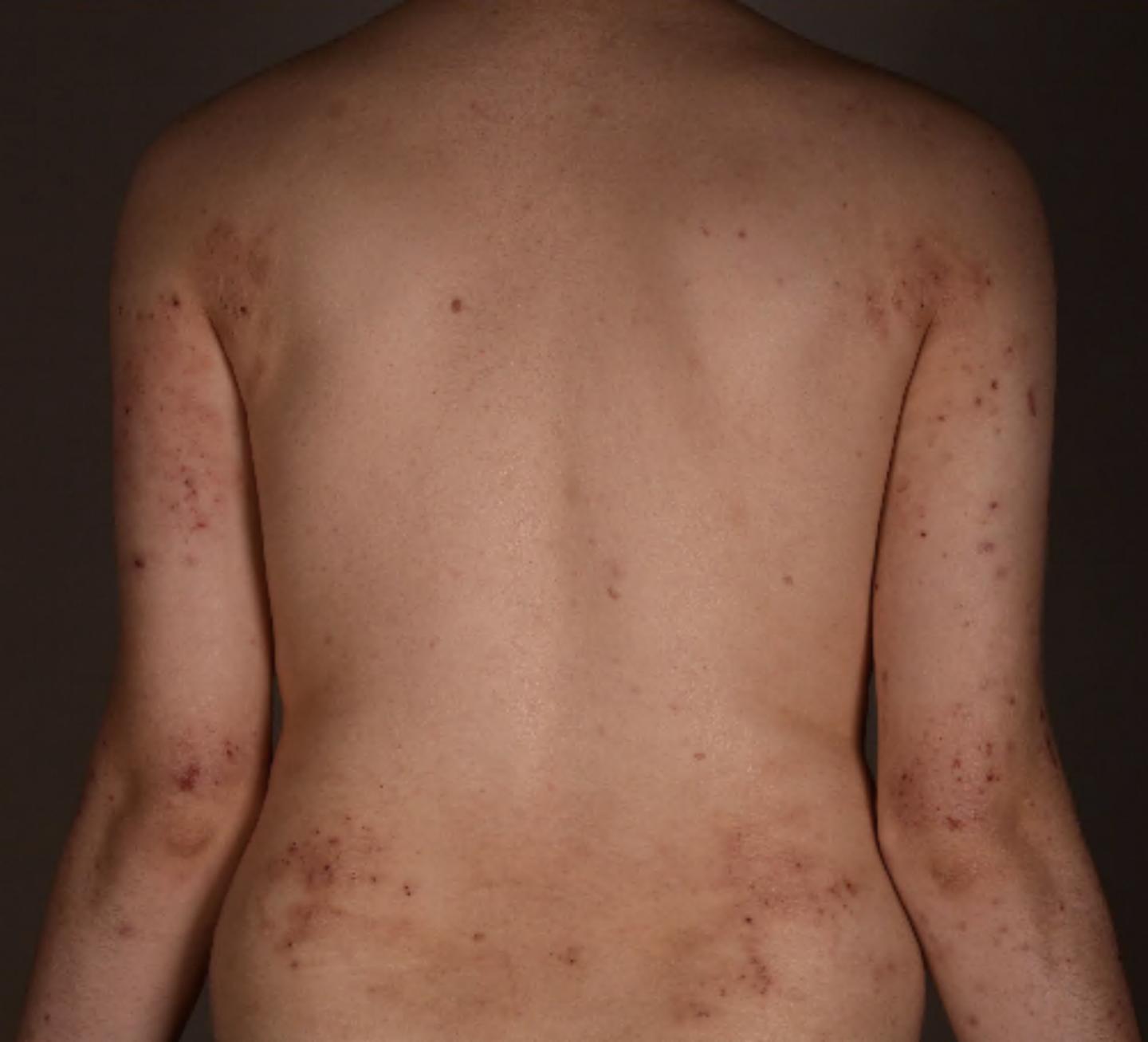 Atopic Dermatitis