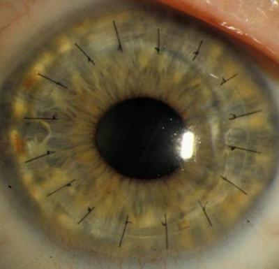 Penetrating Keratoplasty