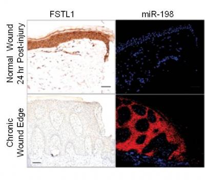 Expression of FSTL1 and miR-198 in Normal Wounds Vs. Chronic Wounds