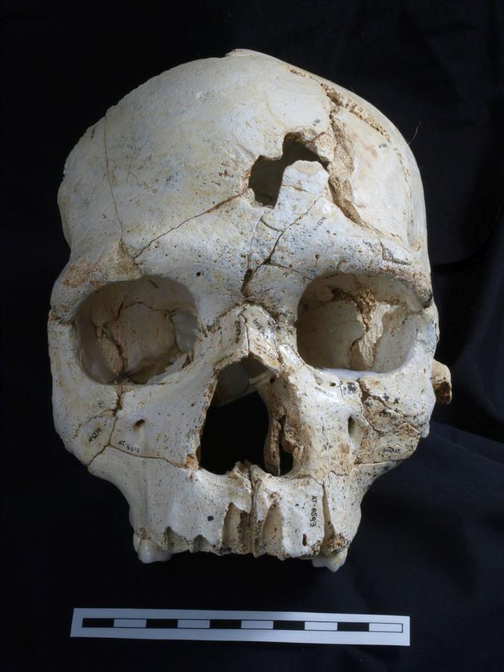 Cranium 17 Bone Traumatic Fractures