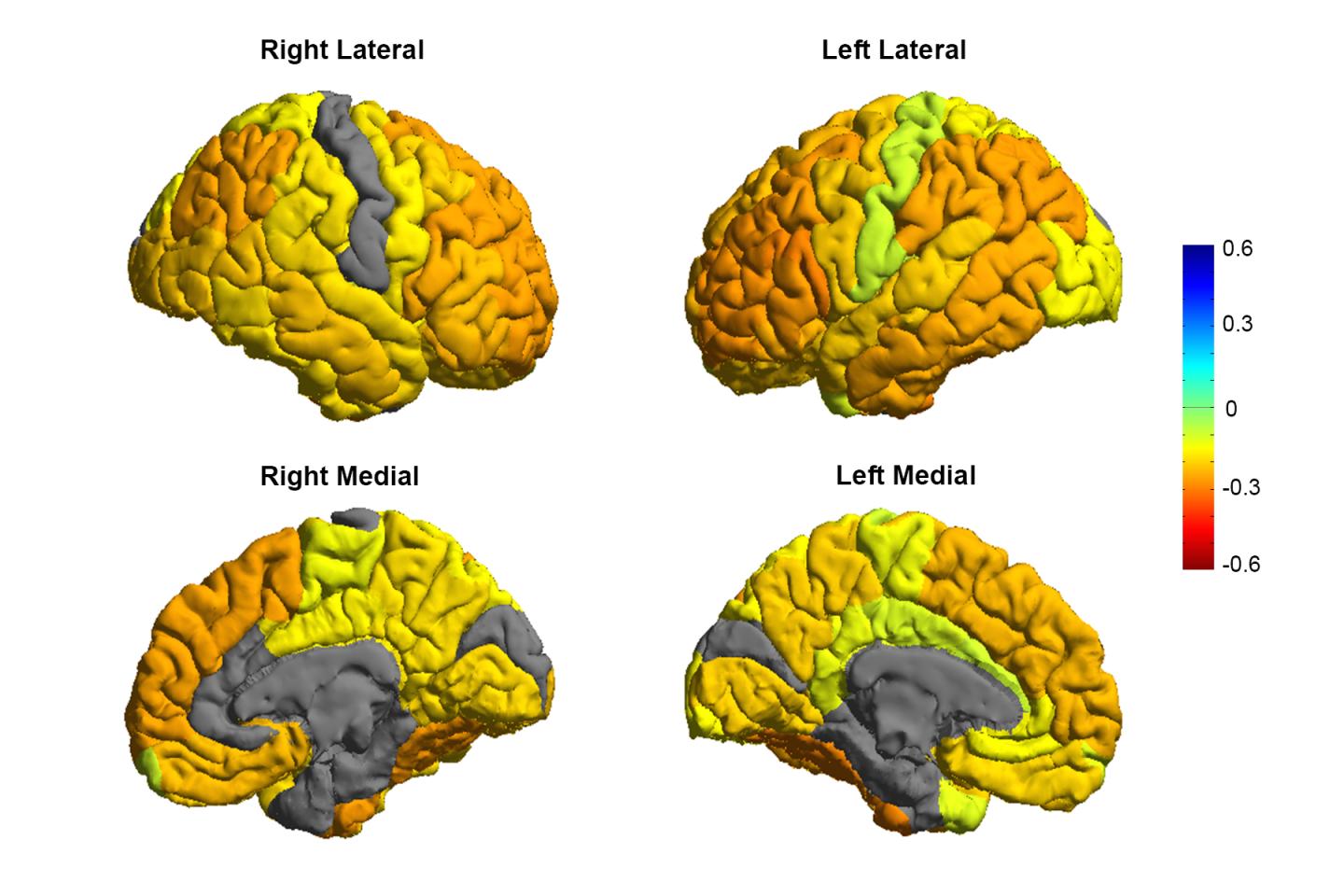 ENIGMA Bipolar Disorder Brain Map