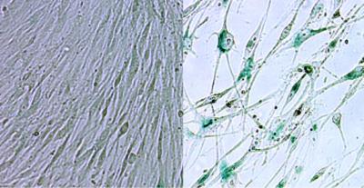 Cigarette Smoking Ages Lung Cells