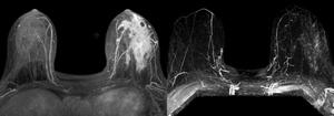 Before and after imaging of breast cancer trial participant