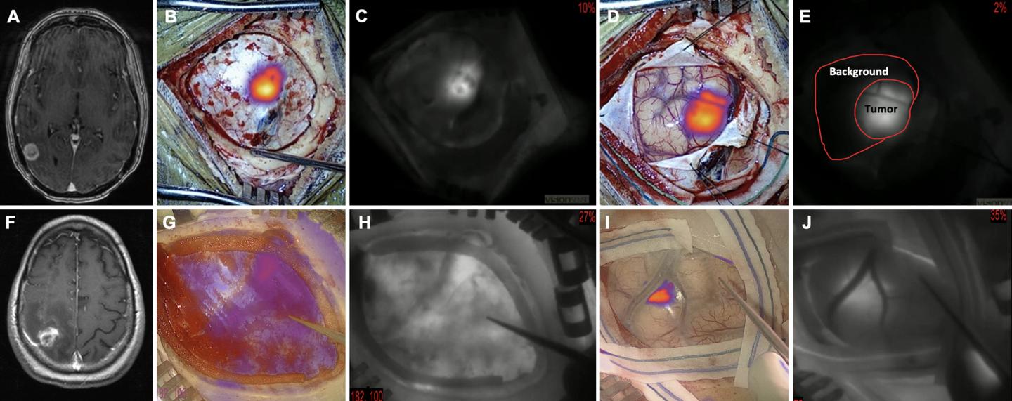 Examples of successful (5 mg/kg) and unsuccessful (2.5 mg/kg) tumor localization through dura/cortex