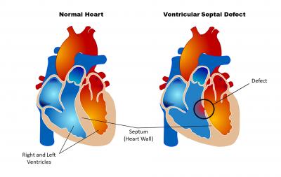 Congenital Heart Defect