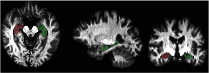 fMRI images of brain of veteran with PTSD