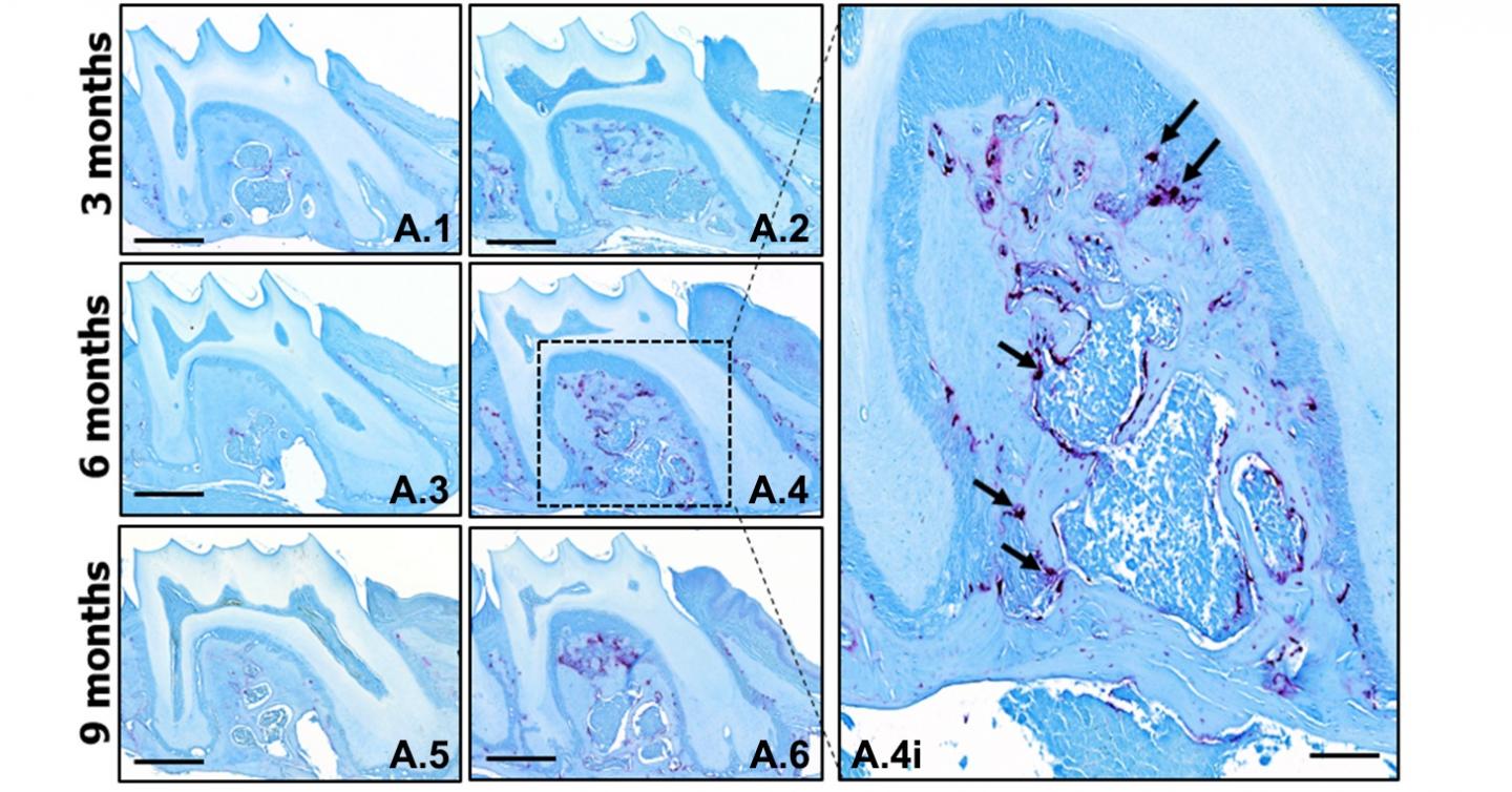 Osteoclasts in Bone with TTP/Without TTP