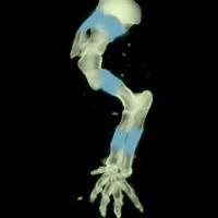 Model Visualization of Abnormal Bone and Joint Formation