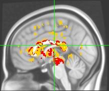 Brain Activation Patterns on fMRI