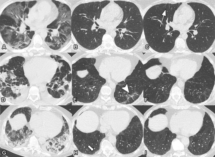 Lung Damage May Persist Long After COVID-19 Pneumonia