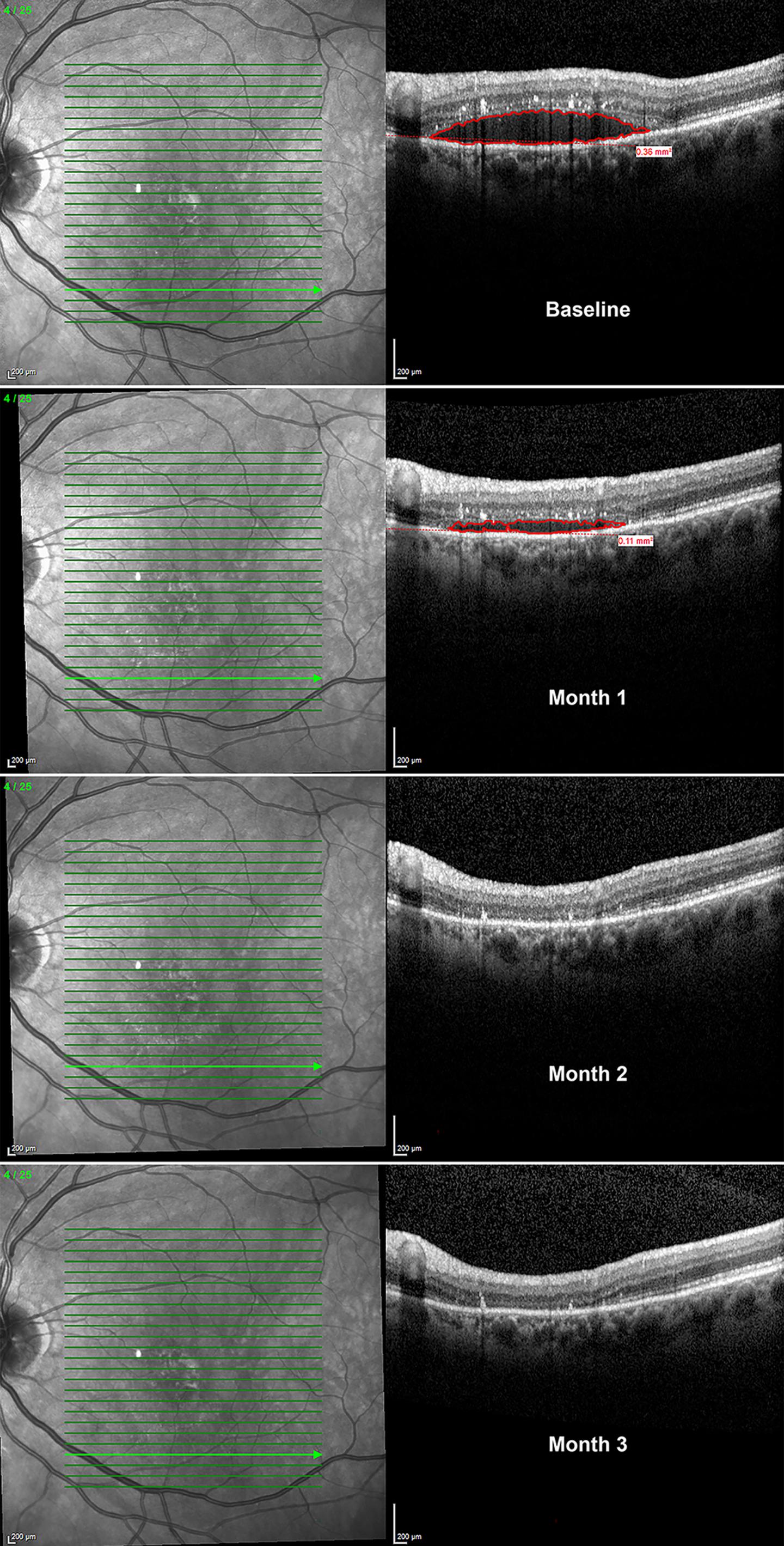 Levodopa May Improve Vision in Patients with Macular Degeneration