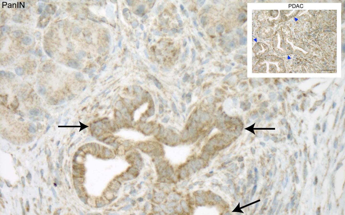 NIX Protein in Common Precursor Lesions