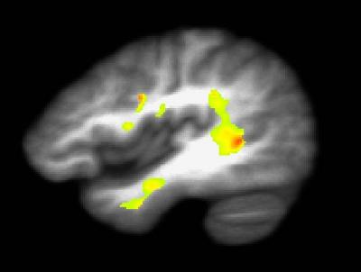 Brain of Marijuana User