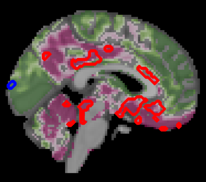 Effects of aging on the brain in type 2 diabetes