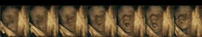 4-D Scan of Fetus at 25 Weeks