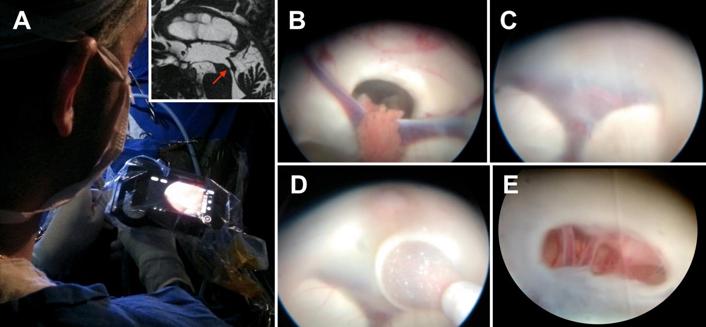 Smartphone-Assisted Neuroendoscopy