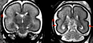 Drinking During Pregnancy Changes Baby’s Brain Structure