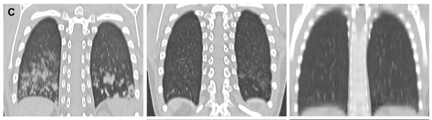 Combating Undetected Lung Inflammation in Patients with an Autoimmune Disorder (2 of 2)