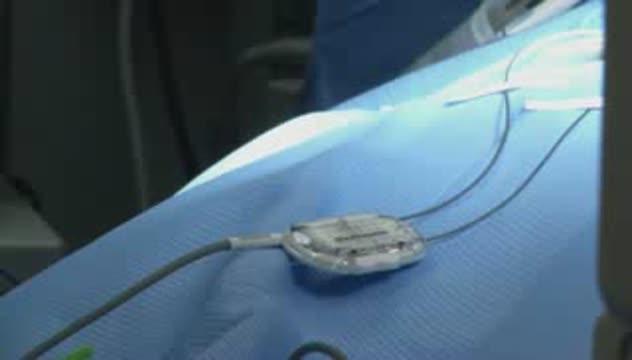 Ohio State's Wexner Medical Center Implants 1 Of First MRI-Safe Devices For Pain