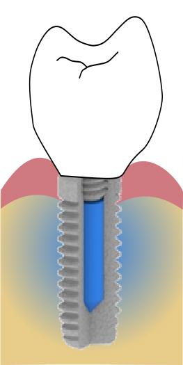 Implant Integrated into the Jawbone and with a Crown on the Tooth