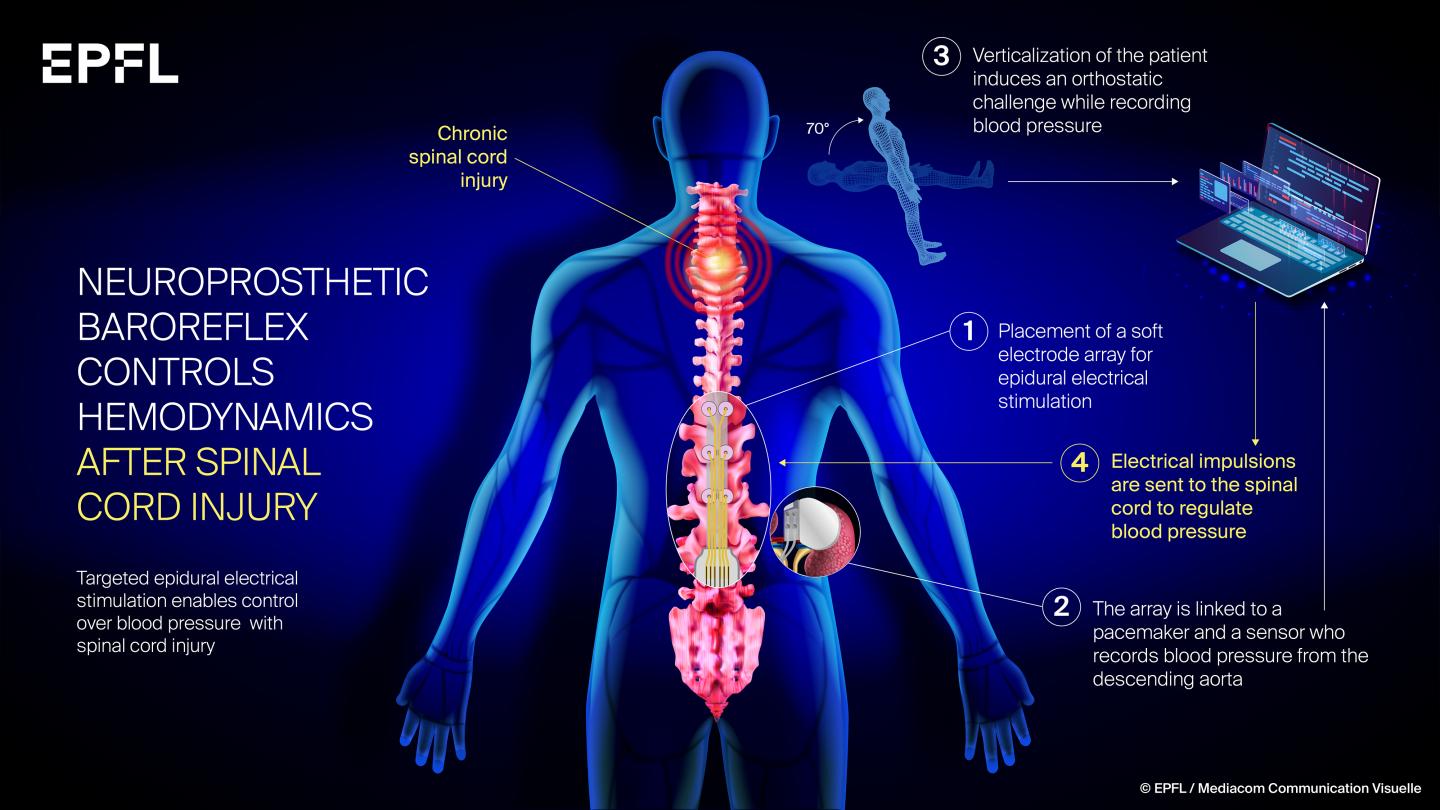 Infographic: restoring control of the blood pressure after spinal cord injury