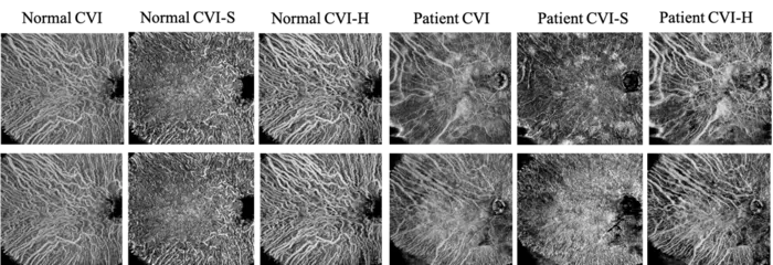 The proposed C-OCTA can be used to identify choroidal abnormalities