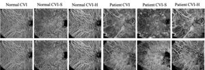 The proposed C-OCTA can be used to identify choroidal abnormalities