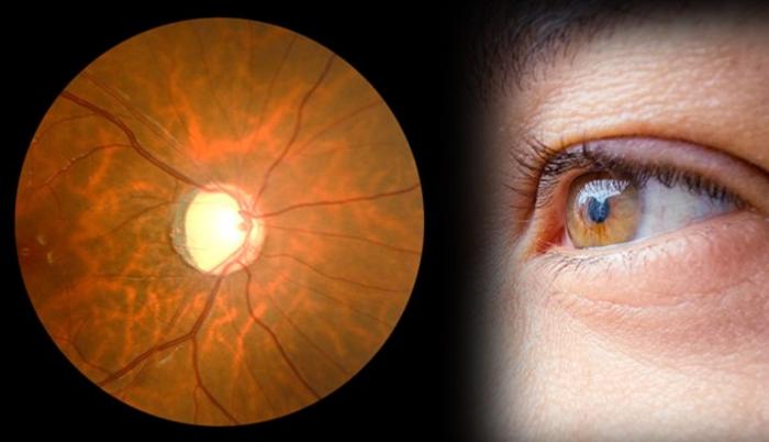 Artificial intelligence (AI)-based research to revolutionize the future of glaucoma treatment