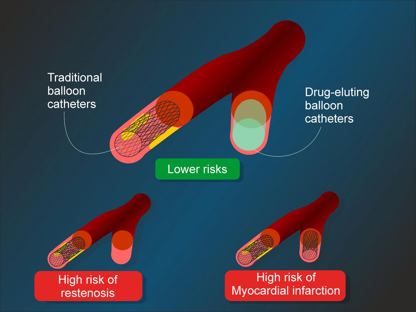 RUDN Medics Suggested Modifications to Coronary Artery Stenting