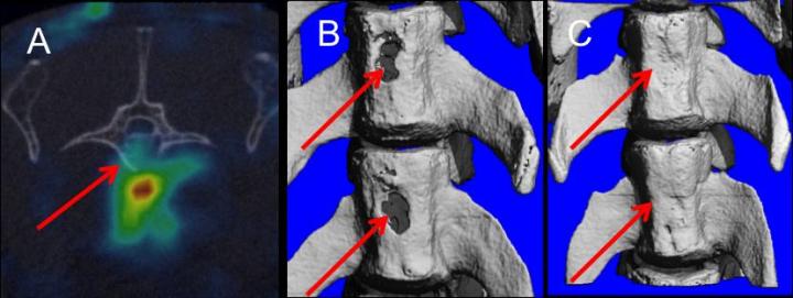 Stem Cells and Hormone Combine to Heal Bone Fractures