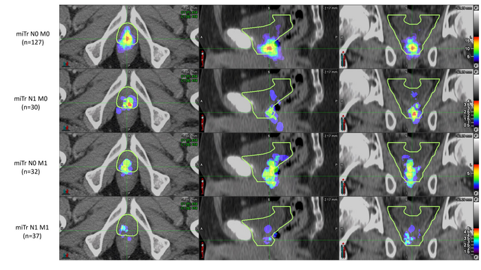 Heat maps of PSMA PET prostatic fossa recurrence in patients