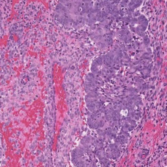 Microscopic image of endometrial cancer cells