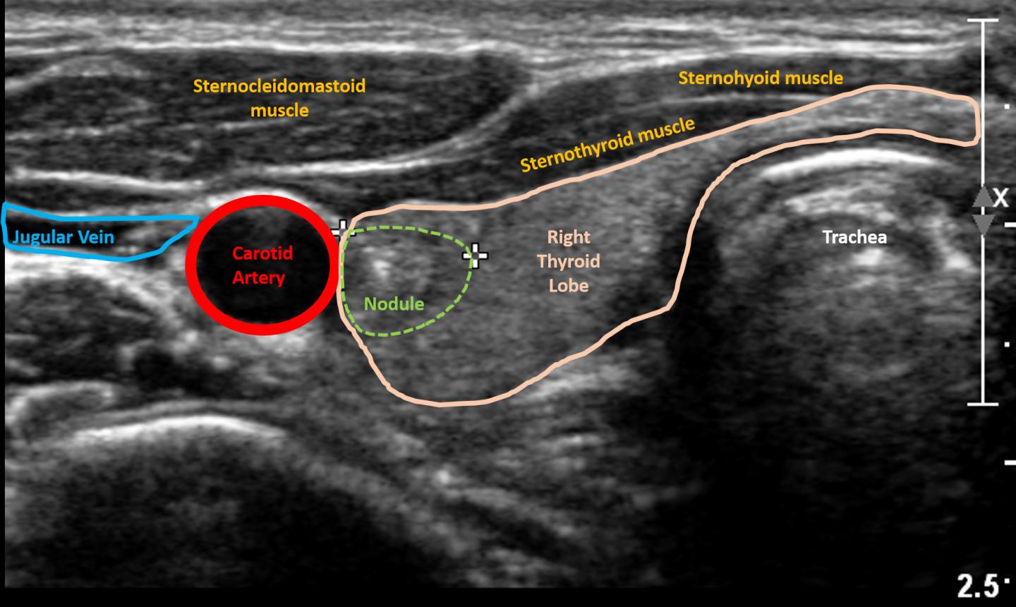 thyroid nodules