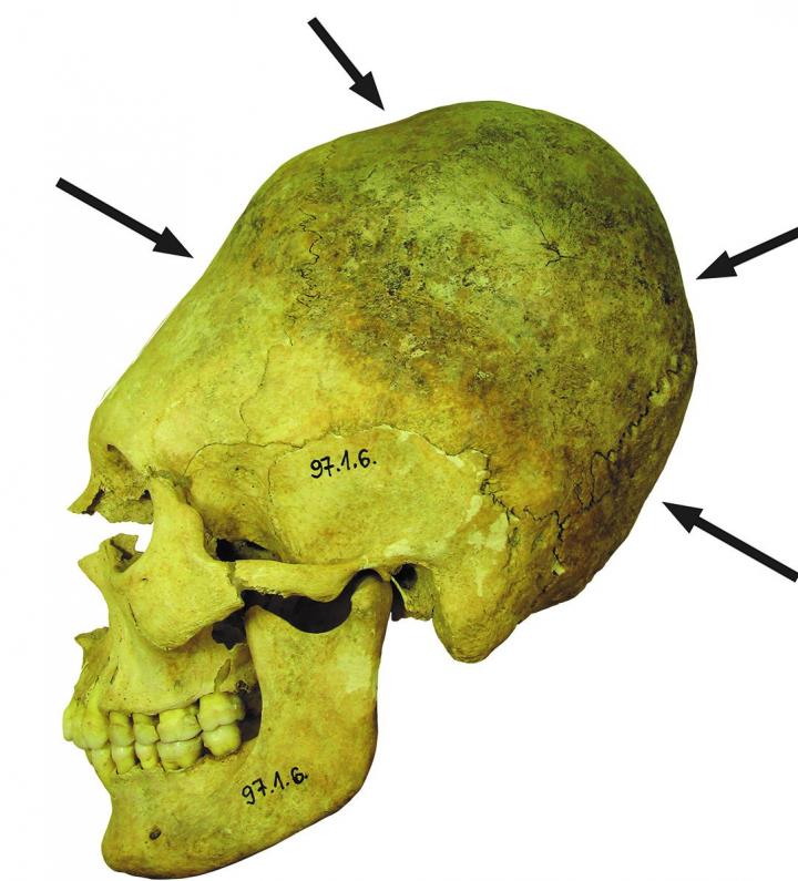 Deformed skulls in an ancient cemetery reveal a multicultural community in transition