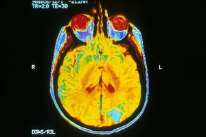 MRI of glioblastoma