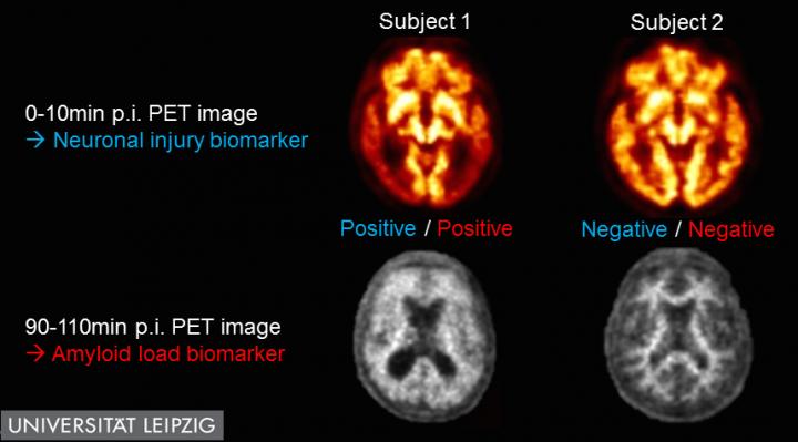 Dual Time-Point, Single PET Session 18F-Florbetaben Images of 2 Cognitively Impaired Subjects