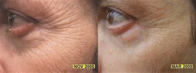 Reducing Skin Wrinkles