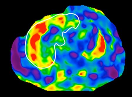 MRE Scan, Liver, UC San Diego School of Medicine