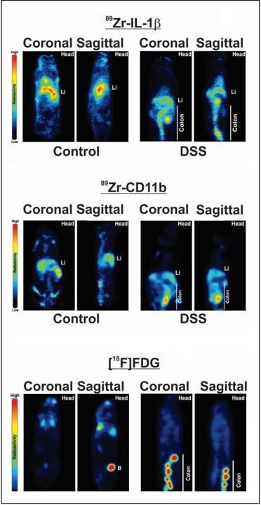 18F-FDG PET Detection of Colonic Inflammation