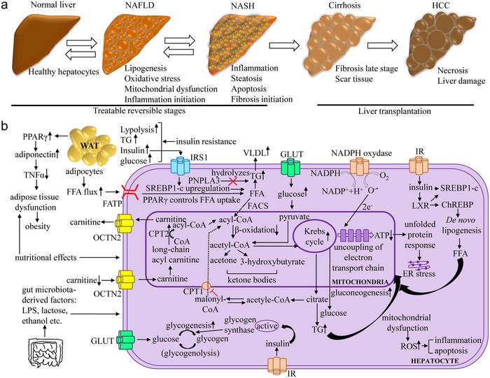 The various stages of the pathophysiological state from NAFLD to HCC can be characterized based on biological and molecular aspects (Panel A). Molecular understanding of multifactorial NAFLD pathogenesis (Panel B).