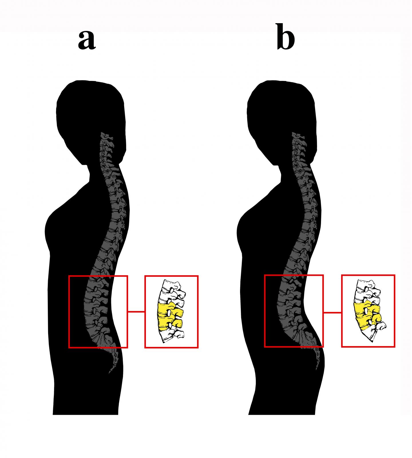 Vertebral Wedging [IMAGE] EurekAlert! Science News Releases