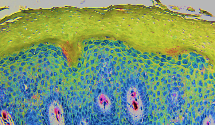 cross-section through the skin of a neurodermatitis patient