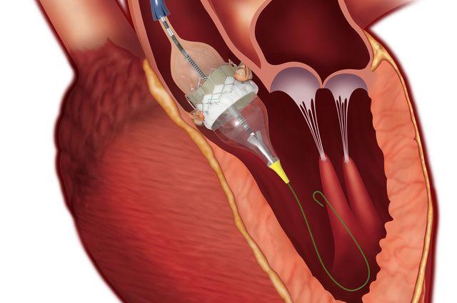 Conscious Sedation Vs. Anesthesia in TAVR Procudure