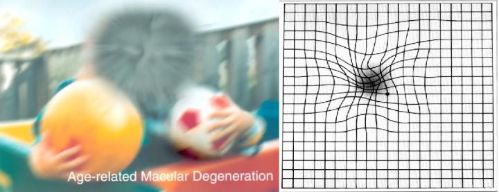 Quest to Prevent Macular Degeneration Continues With UA Researcher's $1.7M NIH Grant