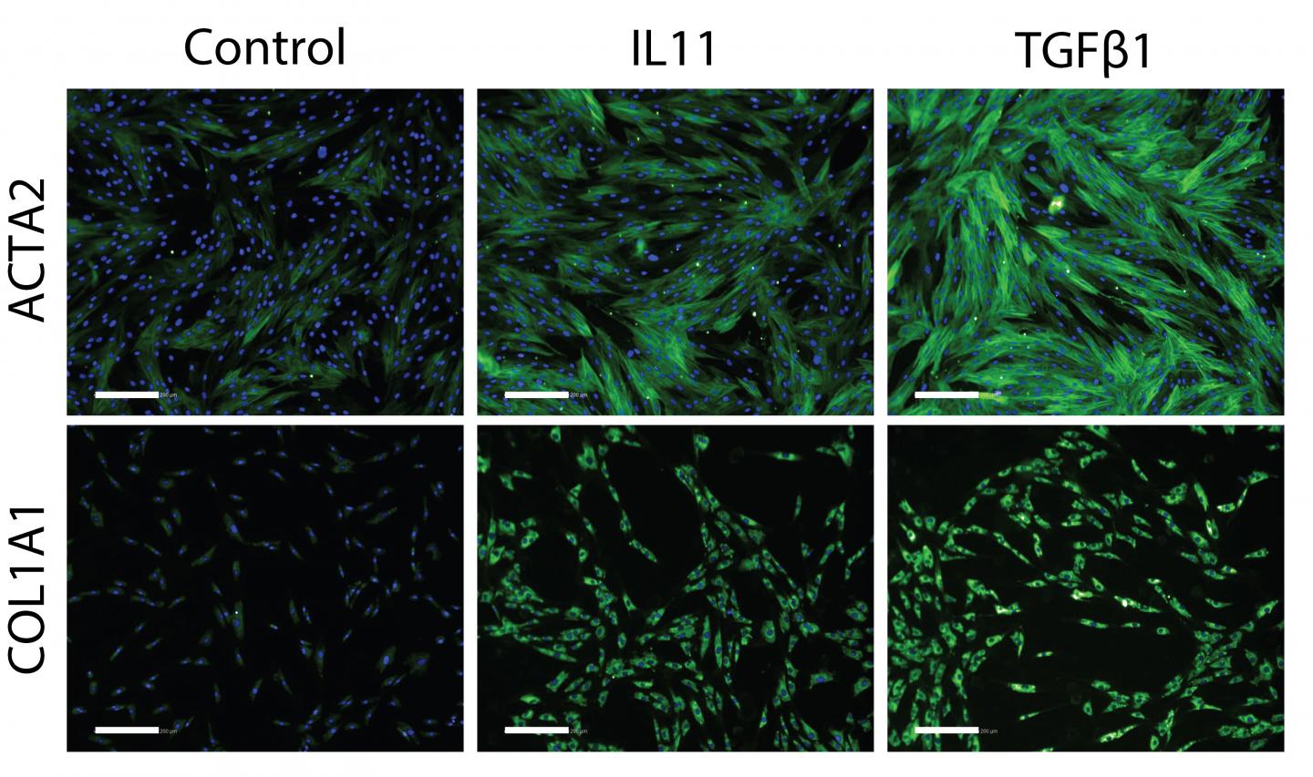 Solving the Mysterious Case of an Inflammatory Molecule's Role in Lung Fibrosis (1 of 4)