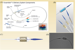 New Pediatric Investigation Article Reviews the Potential of Transcatheter Pulmonary Valve Replacement for Congenital Heart Disorders